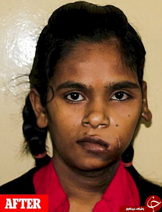 خروج تومور ۲.۸ کیلویی از صورت دختر هندی +تصاویر